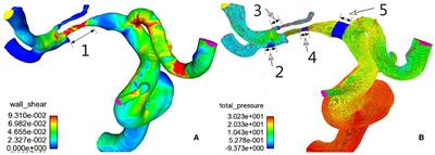 Sub-satisfactory recanalization of severe middle cerebral artery stenoses can significantly improve hemodynamics